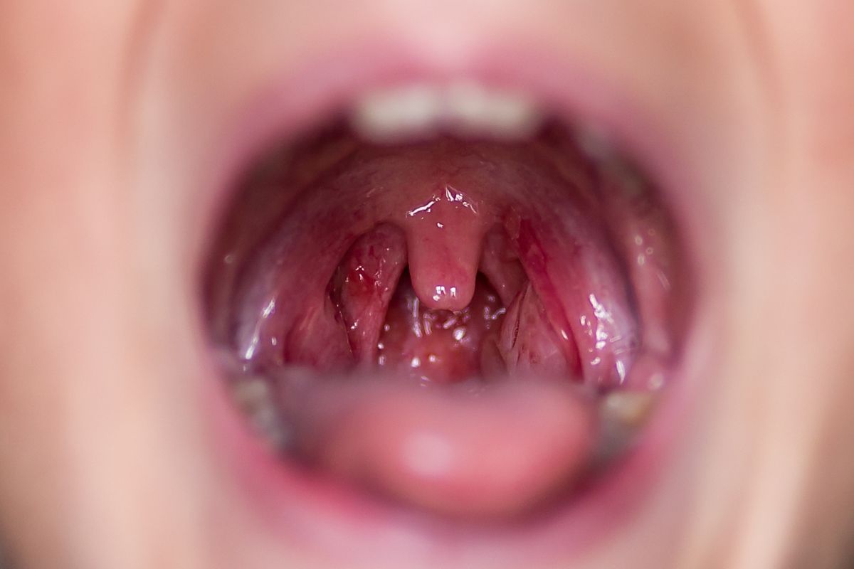Chronic tonsillitis. Herpes